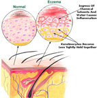 Atopic Dermatitis (ECZEMA) thumbnail